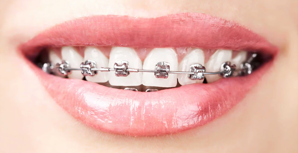 Teeth with self-ligating braces showing clip mechanism.
