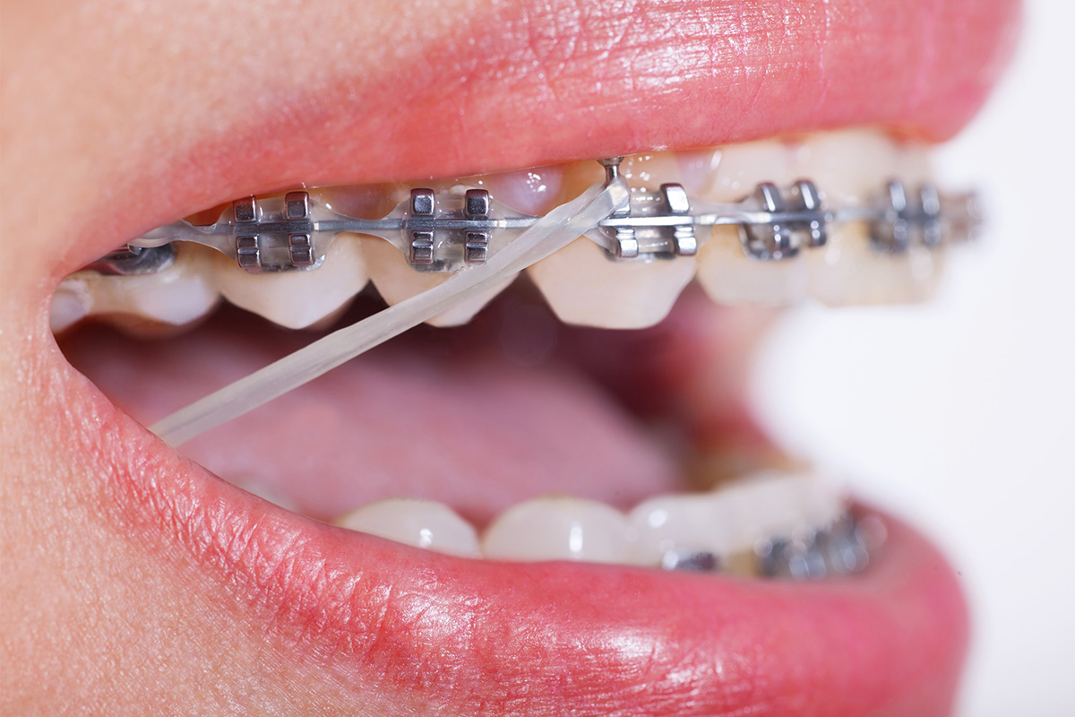 Teeth with metal braces and elastic bands