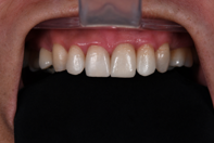 After treatment - One Day Treatment
