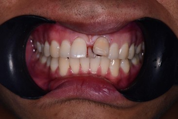 Sebelum Rawatan Braces