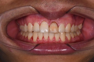 Selepas 2 Tahun Braces