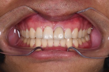 Hasil Akhir Veneer