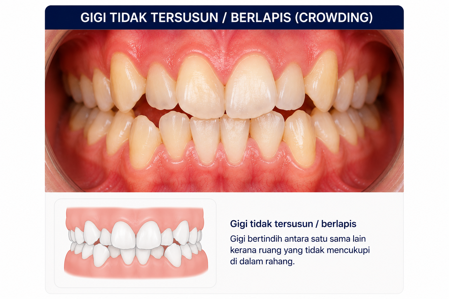 Gigi tidak tersusun / berlapis