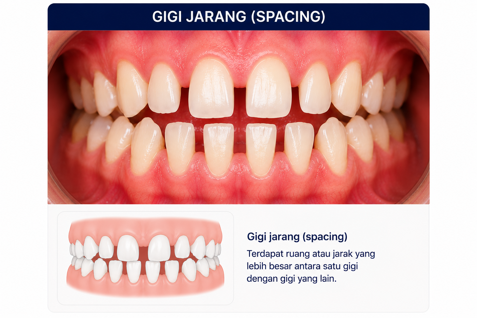 Gigi jarang (spacing)