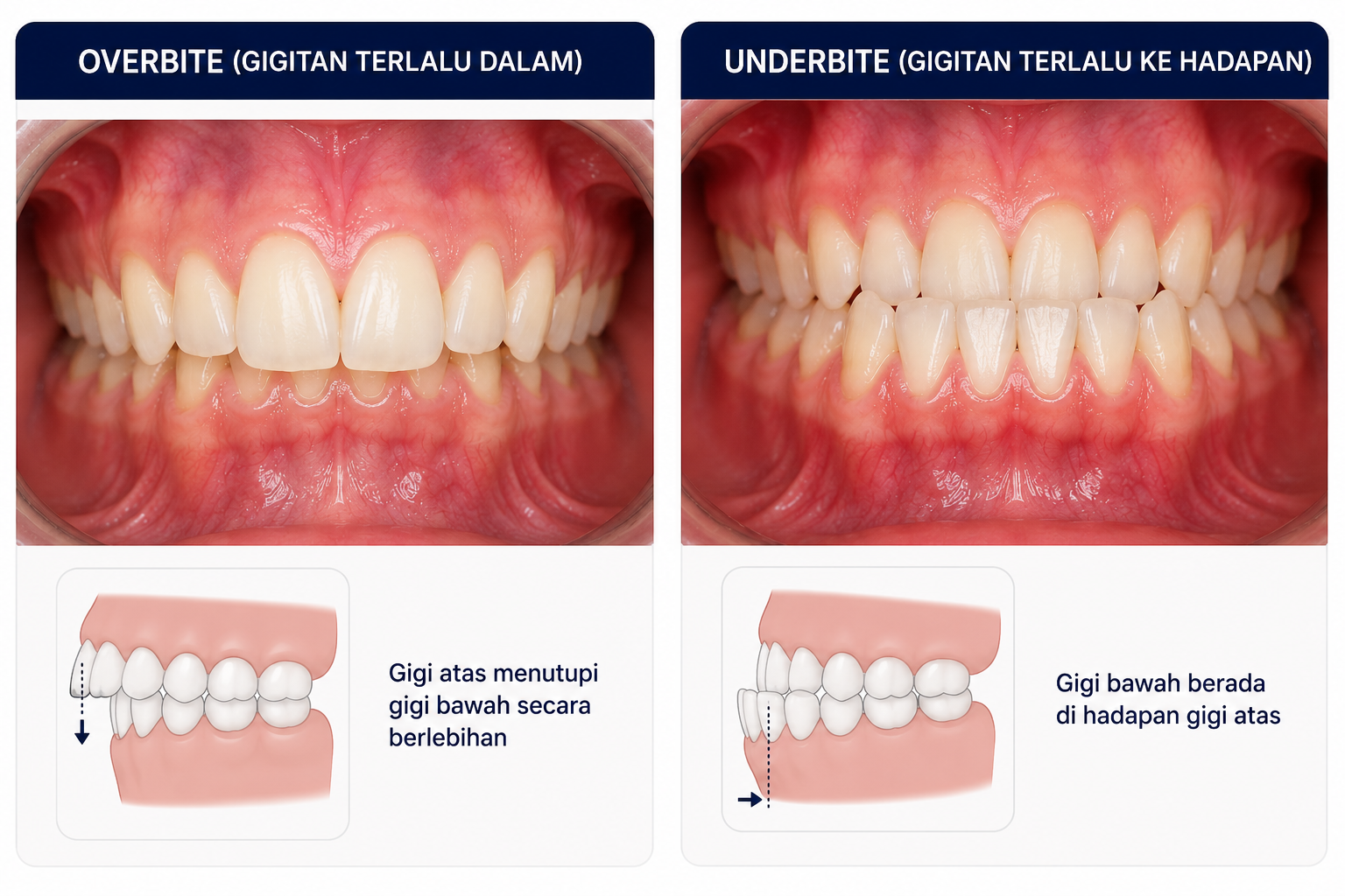 Gigitan tidak betul (overbite / underbite)