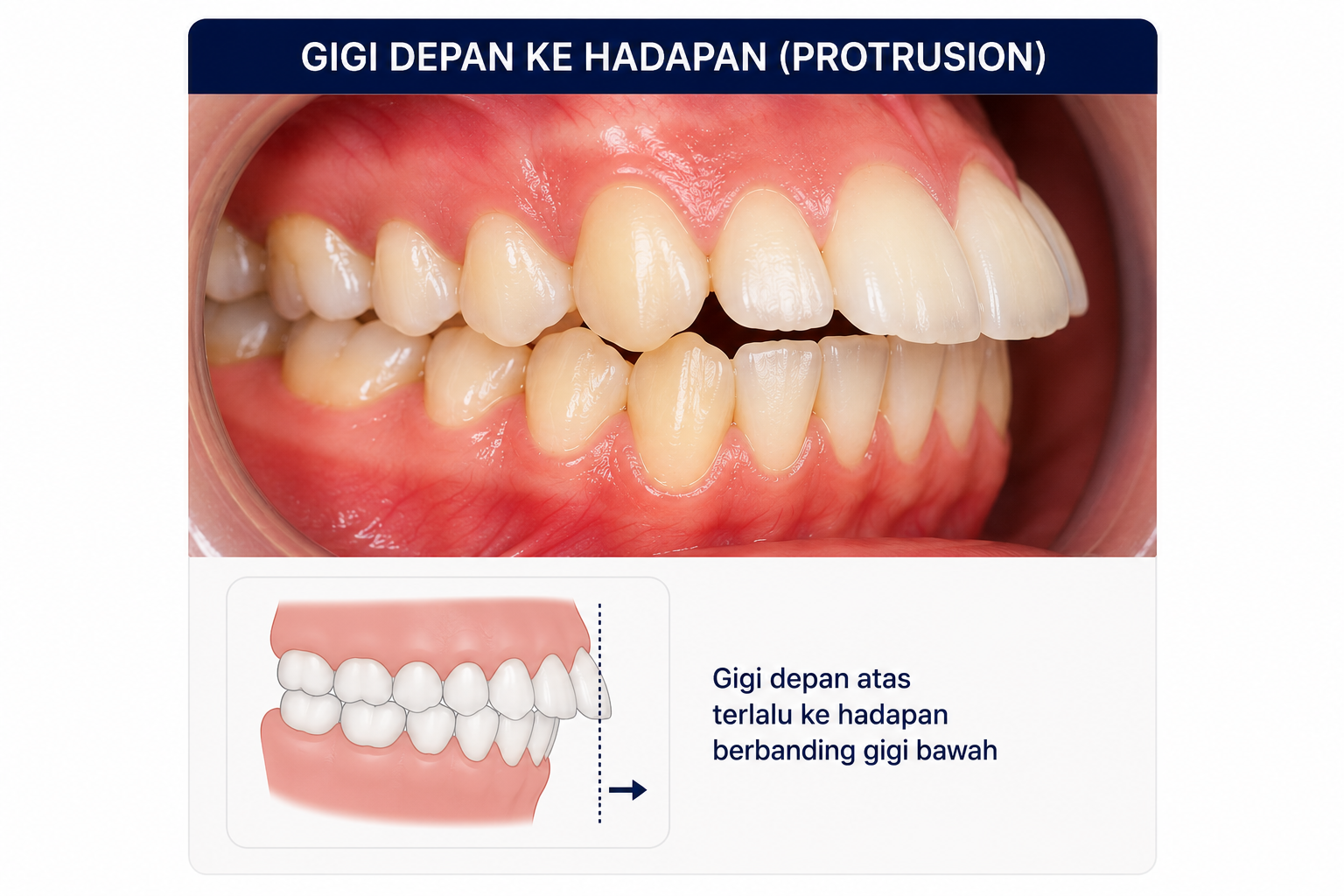 Gigi depan ke hadapan