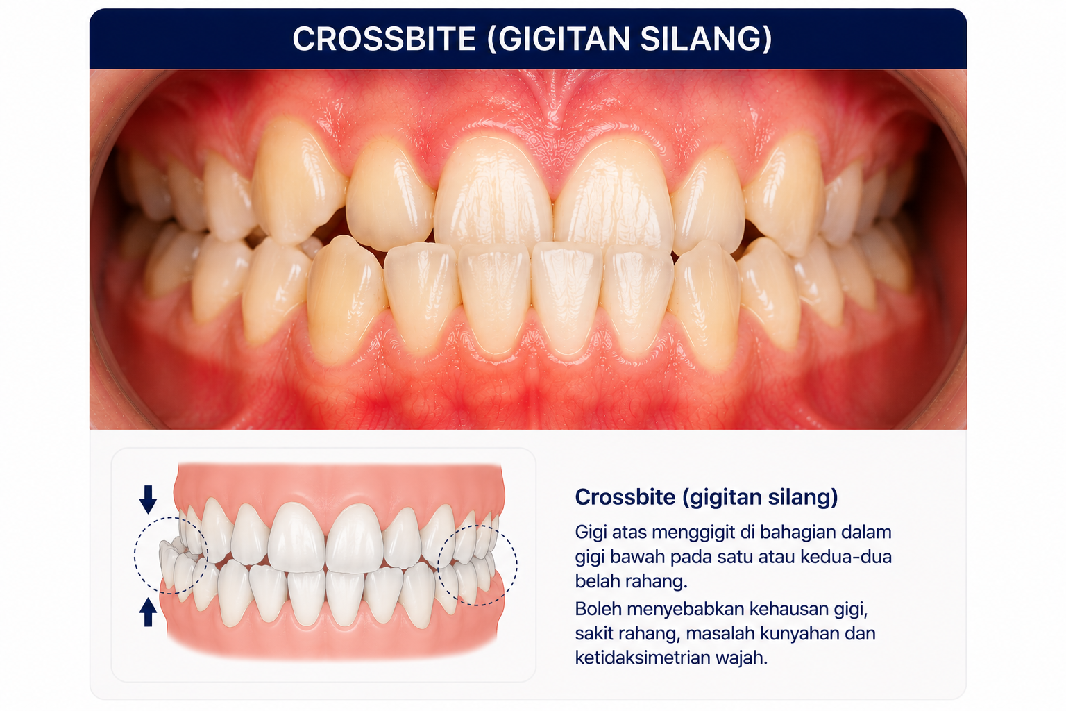 Gigitan silang