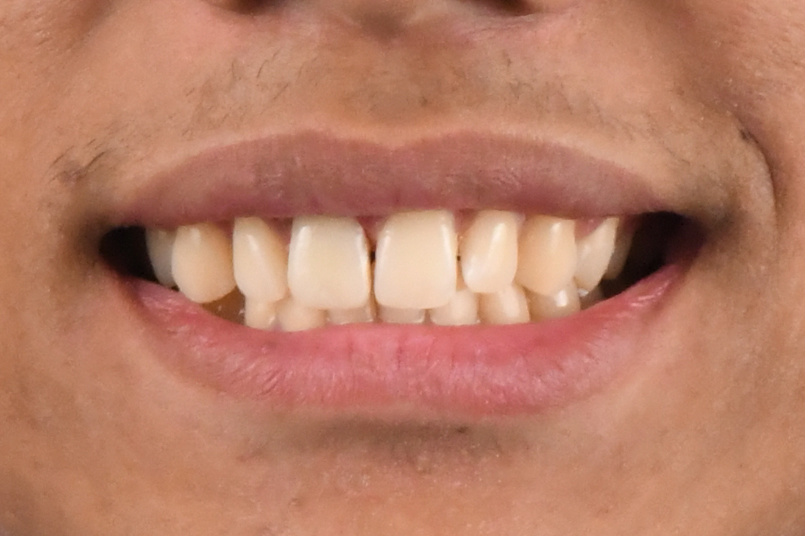 After treatment - Complex Case