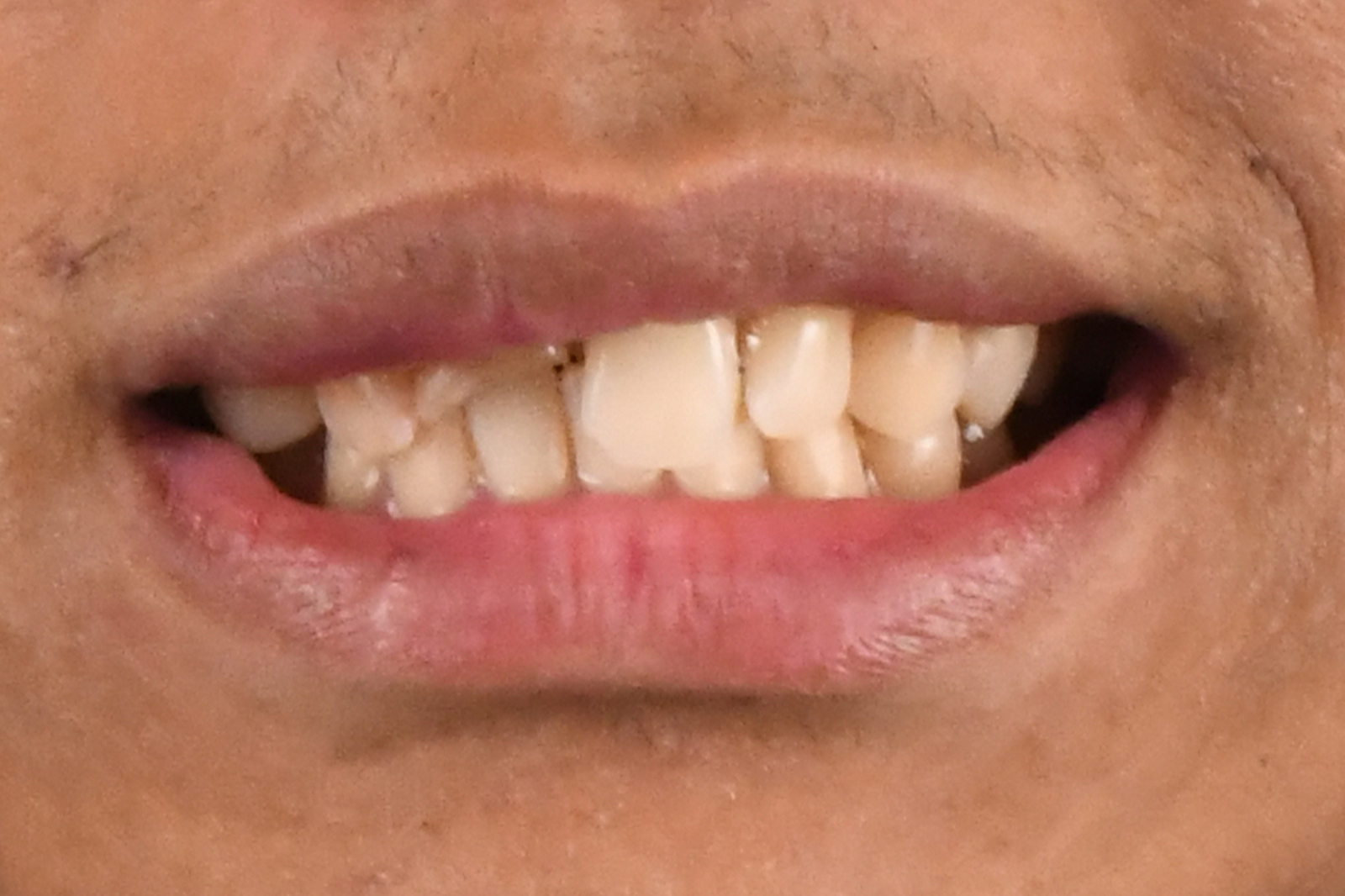 Before treatment - Complex Case