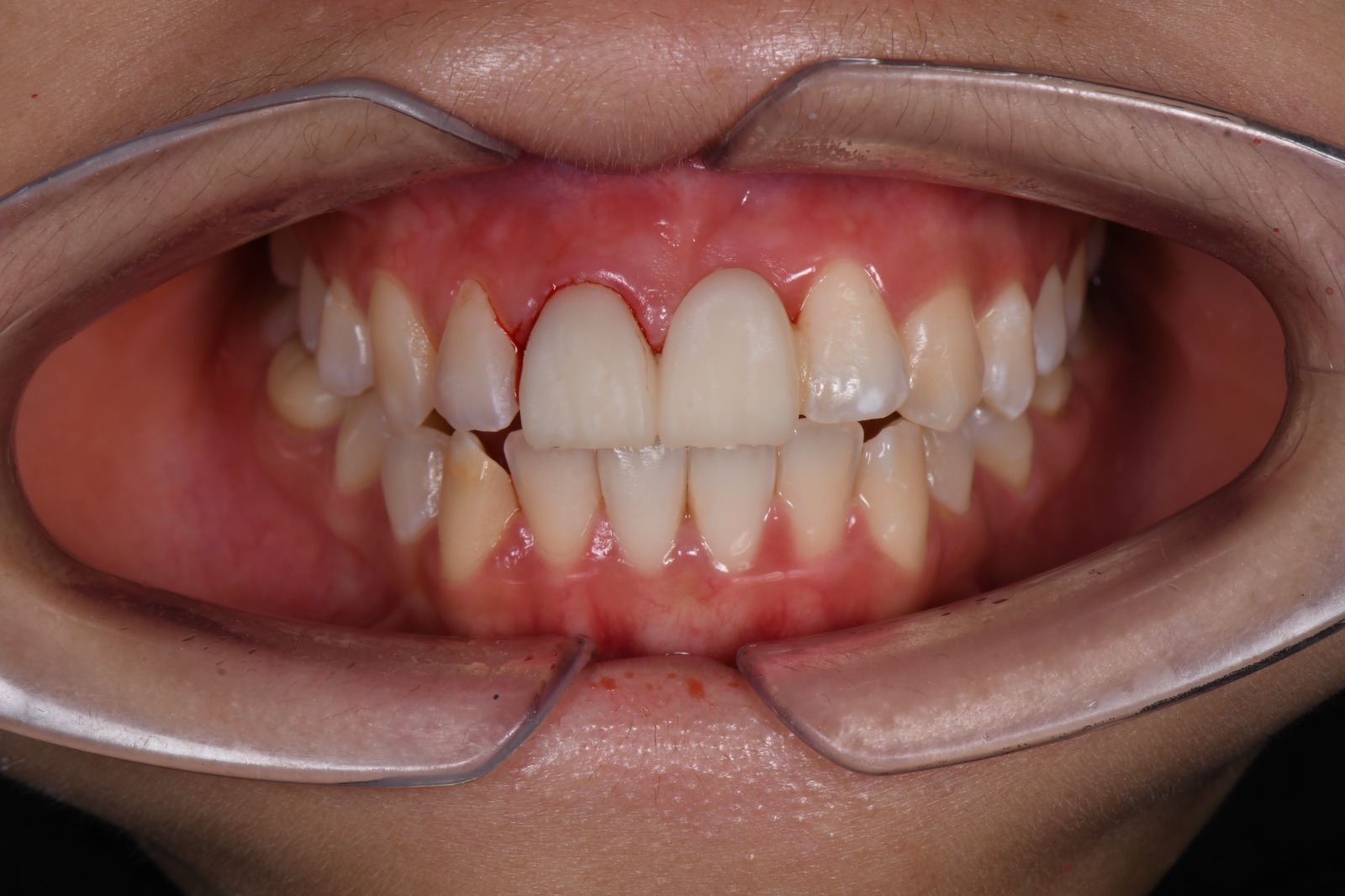 After treatment - Confidence Boost