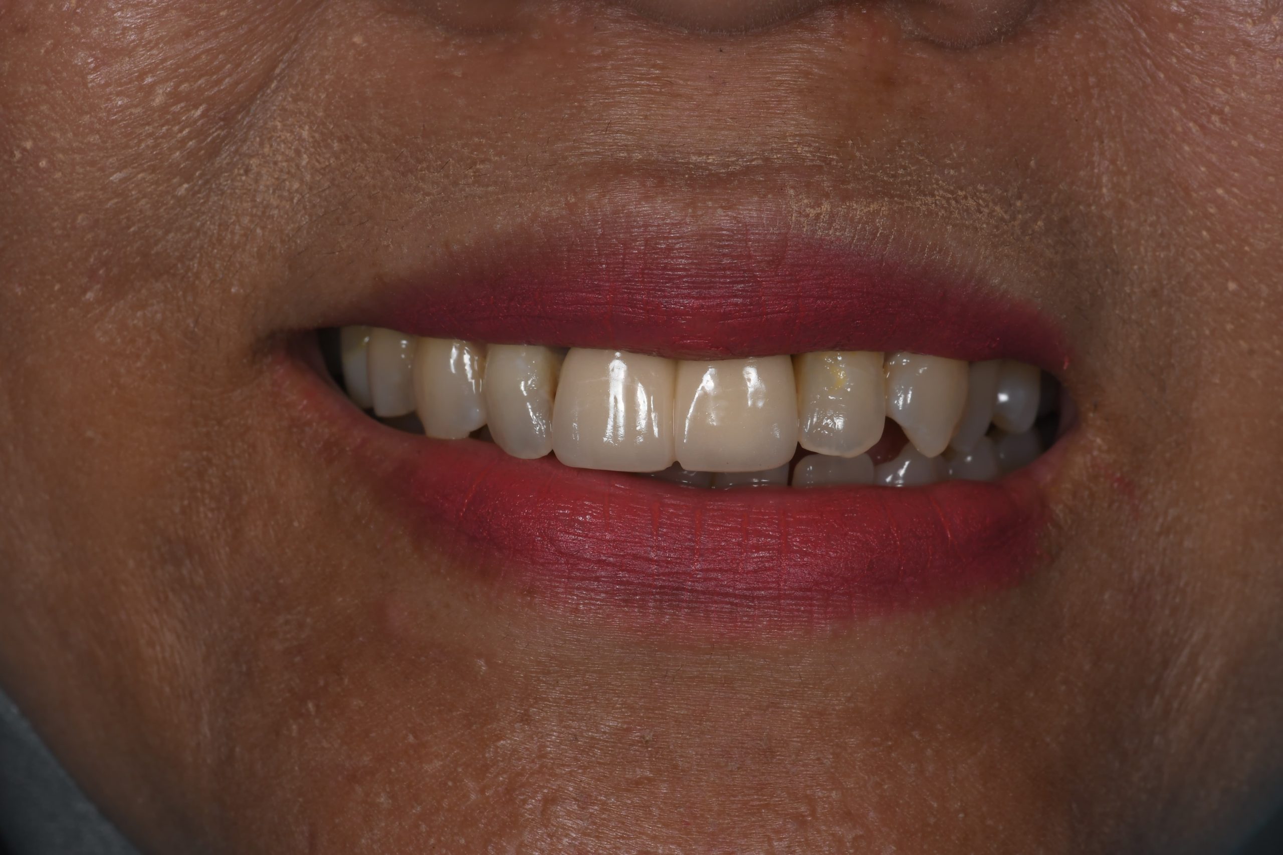 After treatment - Aesthetic Correction