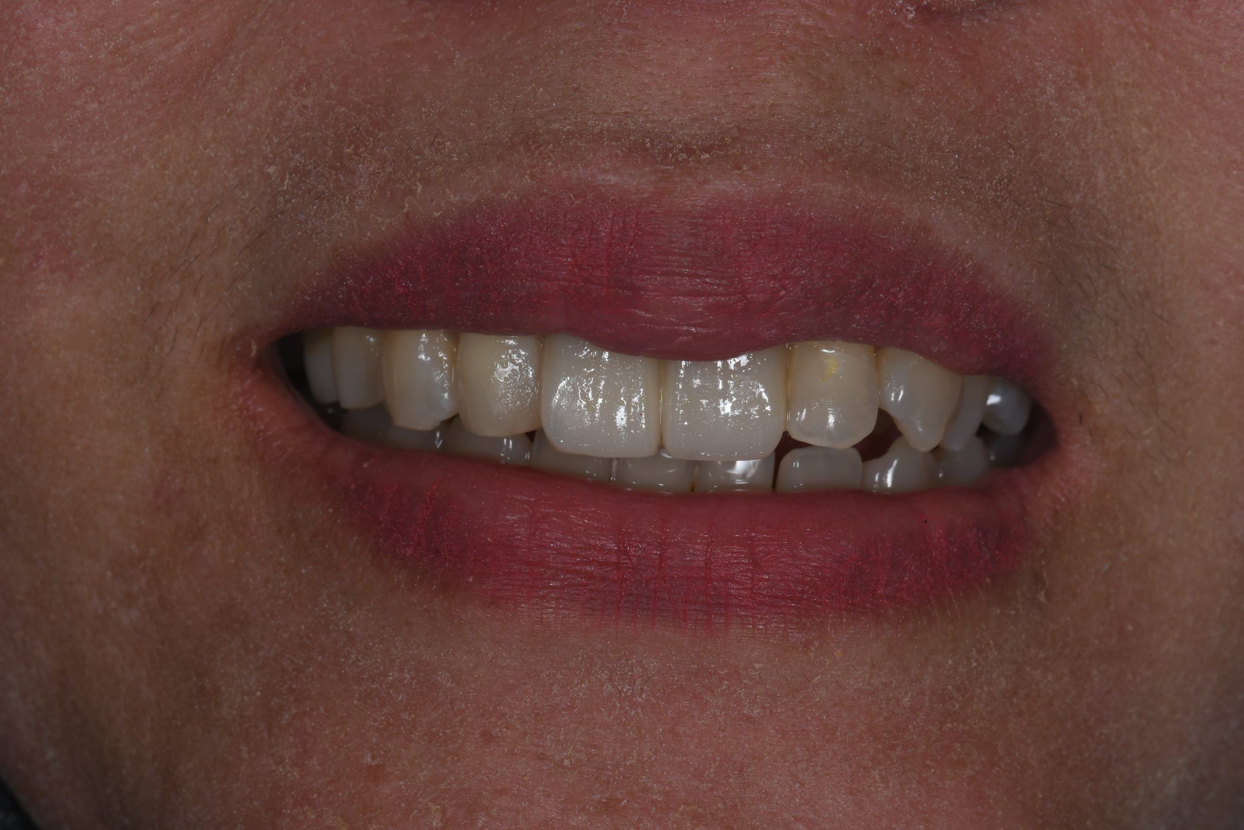 Before treatment - Aesthetic Correction