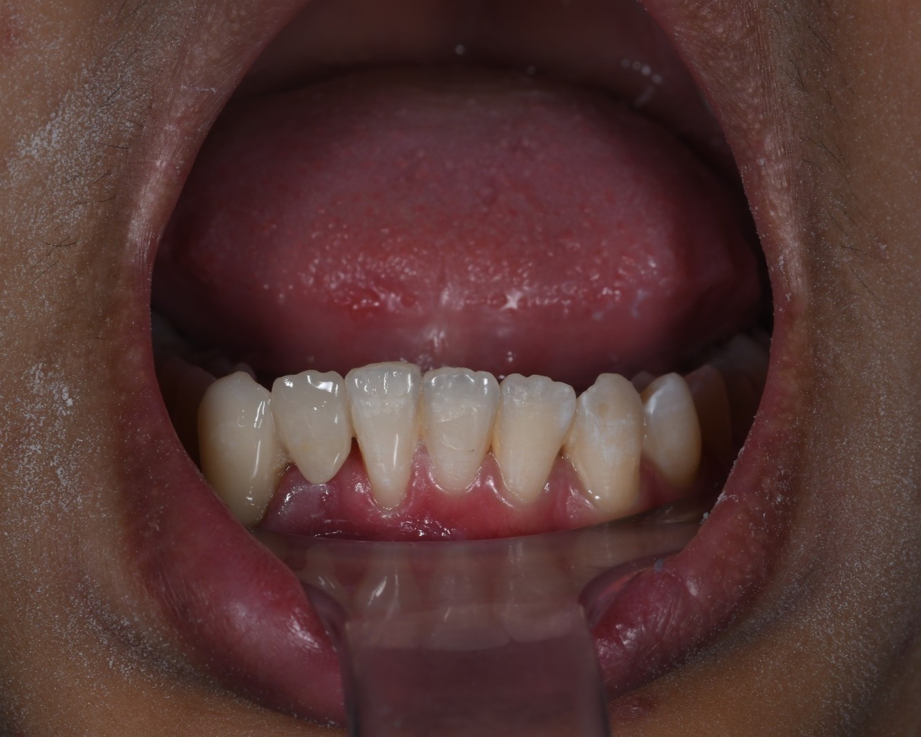 Dental Case 5 After