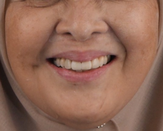 Dental Case 2 After