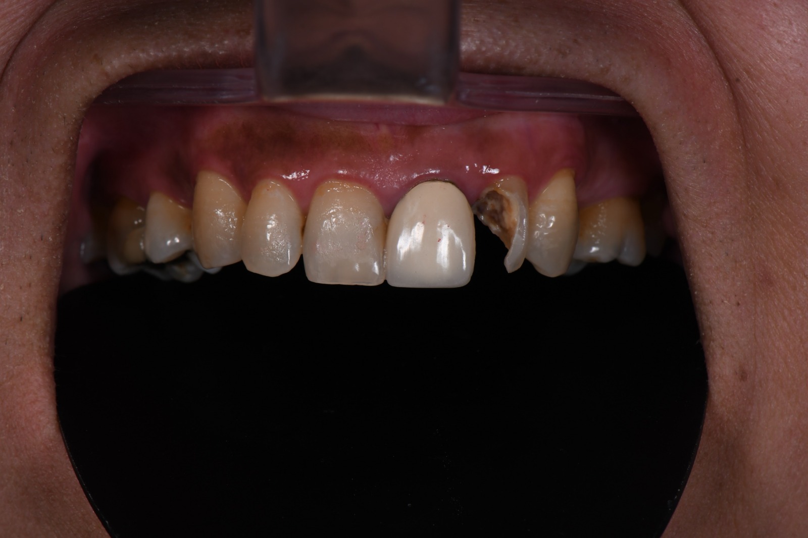 Dental Case 3 Before