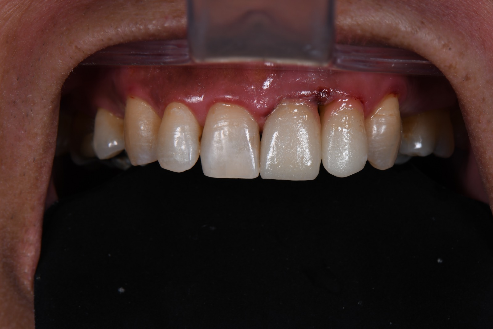 Dental Case 3 After