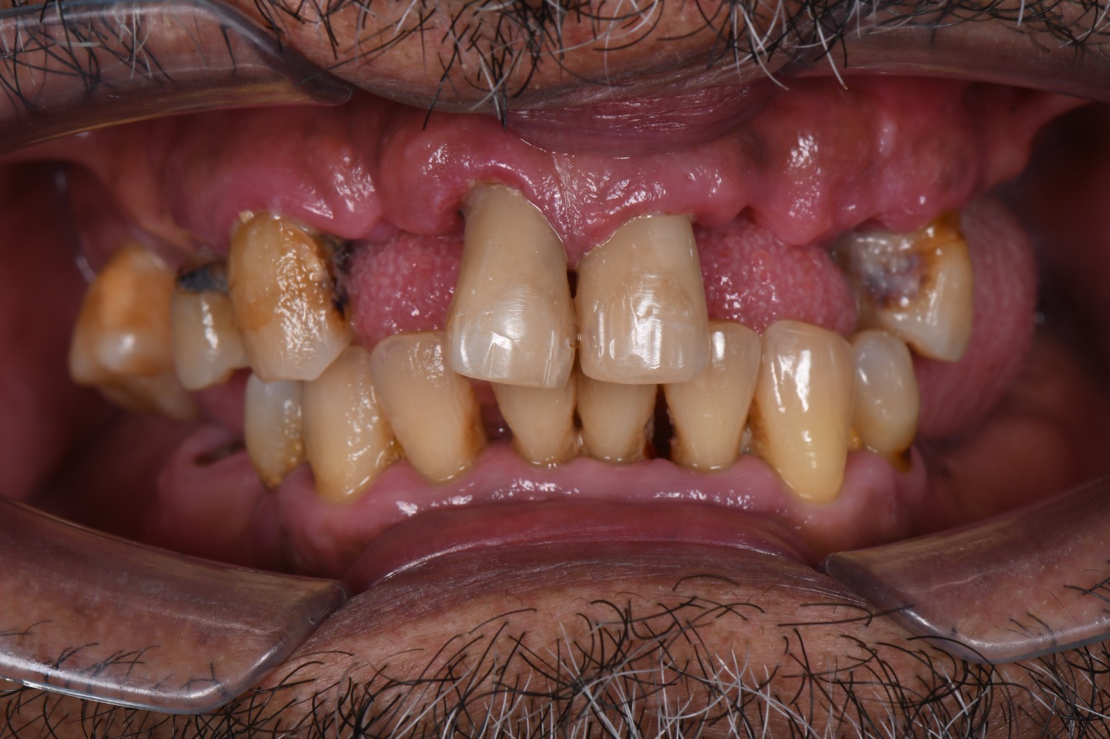 Dental Case 4 Before