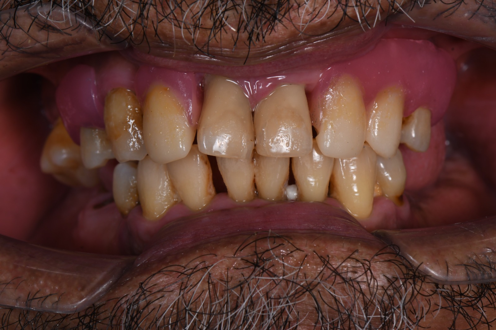 Dental Case 4 After