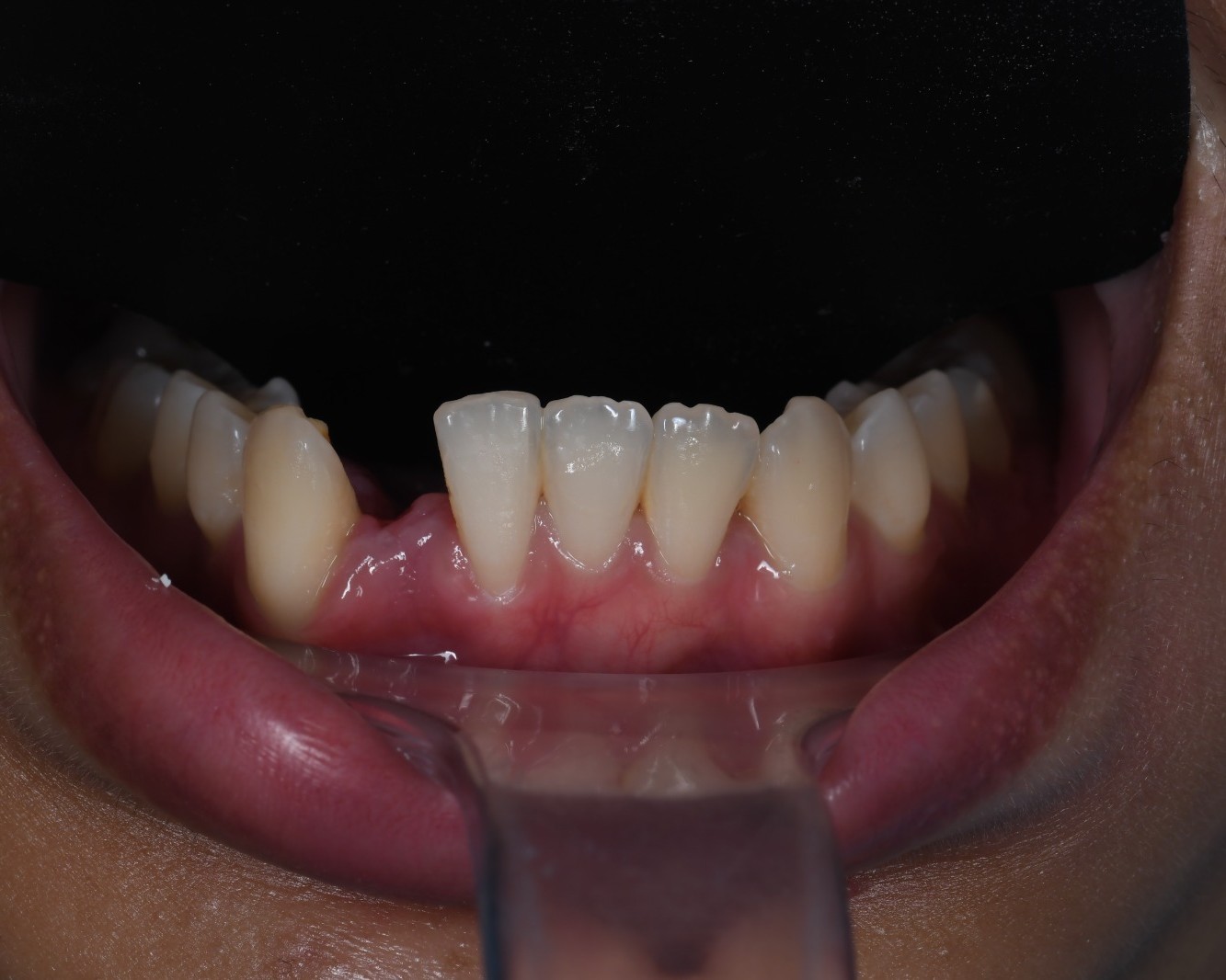 Dental Case 5 Before